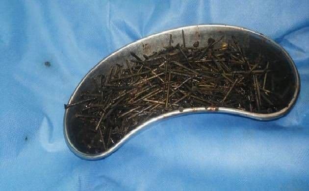या माणसाच्या पोटातून निघाले तब्बल ६३९ खिळे....वाचा हा काय प्रकार आहे !!