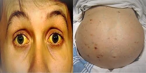 कावीळ आणि हेपॅटायटिसमध्ये काय फरक आहे? जाणून घ्या या रोगाची लक्षणे आणि उपाय!!