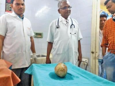 पोटातून काढलेल्या दगडाची गोष्ट !!!