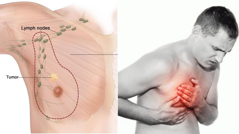पुरुषांनाही स्तनांचा कर्करोग होतो का ? जाणून घ्या पुरुषांच्या ‘ब्रेस्ट कॅन्सर' बद्दल !!