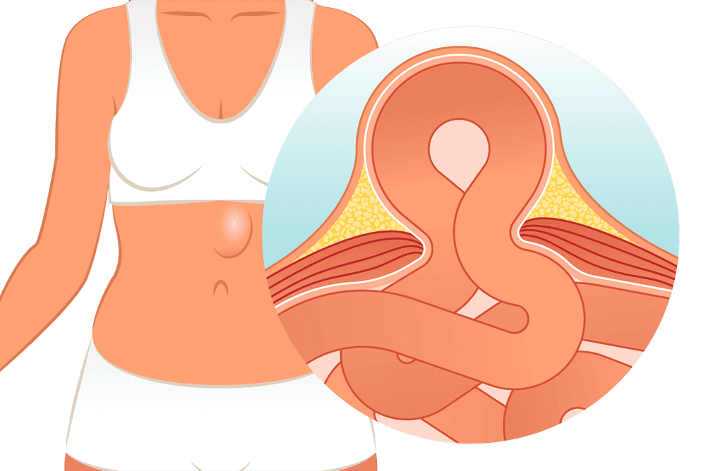 हर्नियाचे प्रकार, लक्षणं आणि उपचार पटकन वाचून घ्या आणि तो होऊ नये म्हणून काय काळजी घ्यावी हे ही वाचाच..