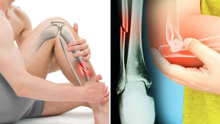 फ्रॅक्चरचे १५ प्रकार, तुमचं यातल्या कुठल्या प्रकारचं फ्रॅक्चर झालं होतं??