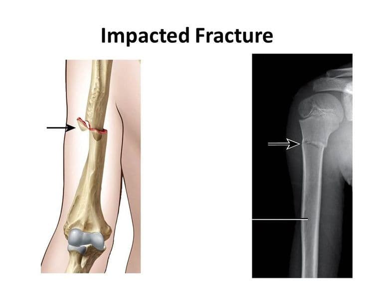 Impacted Fracture - एखादे हाड तुटते तेव्हा त्या हाडाचा हिस्सा दुसऱ्या हाडांमध्ये घुसण्याची स्थिती.