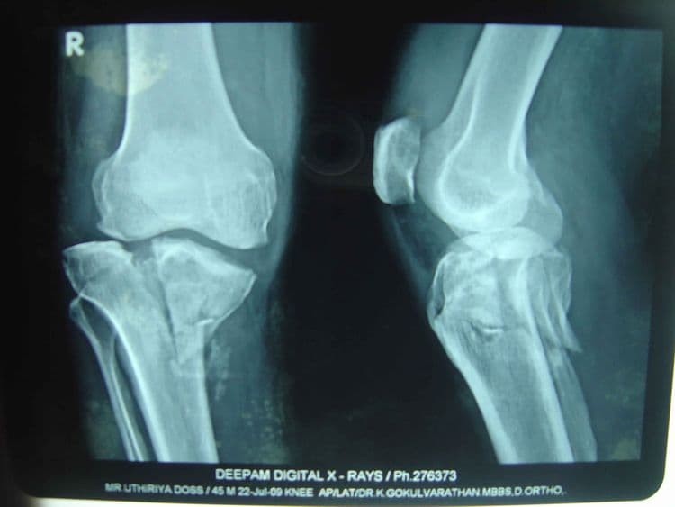 IntraArticular Fracture - हाडासोबतच सांध्याचा पृष्ठभाग सुद्धा फ्रॅक्चर होणे.