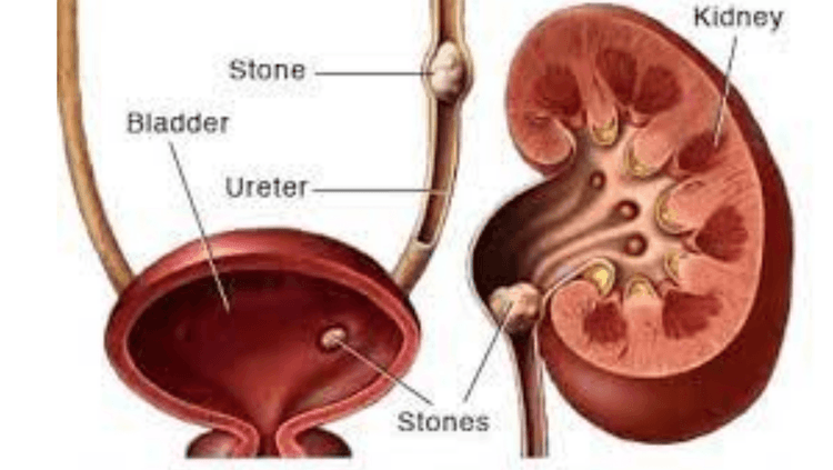 एका तासात २०६ मुतखडे काढले!! मुतखडे होणे टळण्यासाठी आपण काय करु शकतो?