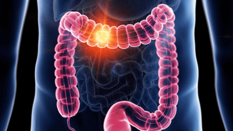 ५  मोठ्या आतड्याचा कर्करोग …..