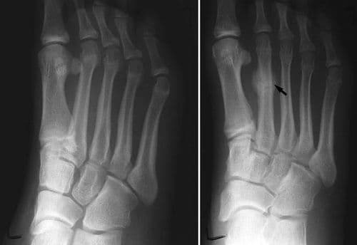 Stress Fracture - विशिष्ट भागावर नेहमी दबाव किंवा ताण पडून तुटणे. हे फ्रॅक्चर खेळाडूंमध्ये जास्त आढळून येते. 