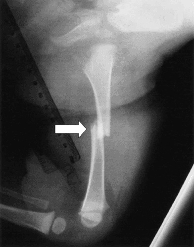Transverse Fracture - हाडाचा सरळ सरळ मध्यभागातून तुकडा पडणे. 