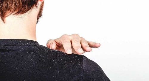 केसातल्या कोंड्याचा त्रास सगळ्यांना का होत नाही असा प्रश्न पडलाय? उत्तर इथं आहे!!