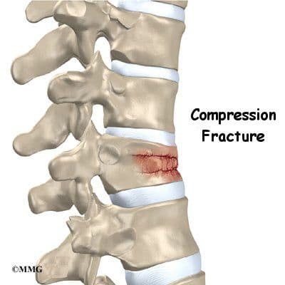 Compression (Crush) Fracture - हे शक्यतो पाठीच्या कण्यातील मऊ हाडांमध्ये आढळते. याचे कारण ऑस्टीओपोरोसिस असते.