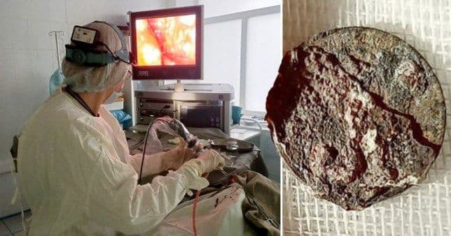 नाकात अडकलेलं नाणं तब्बल ५० वर्षानंतर कसं काढण्यात आलं ? एवढ्या वर्षात पत्ता कसा लागला नाही ?