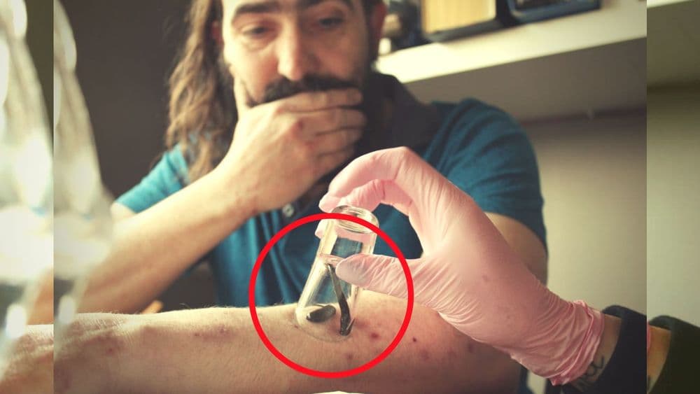 जळू लावणे - एकेकाळी गावठी समजला जाणाऱ्या उपचाराला मिळाली आंतरराष्ट्रीय मान्यता!!