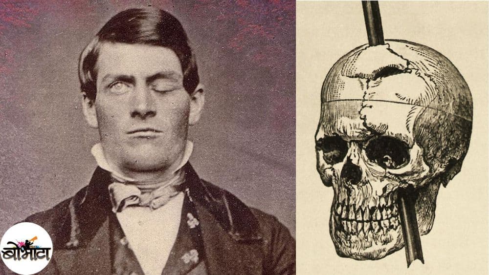 आपला मेंदू काय काम करतो याचा शोध या विचित्र अपघातामुळं लागला..