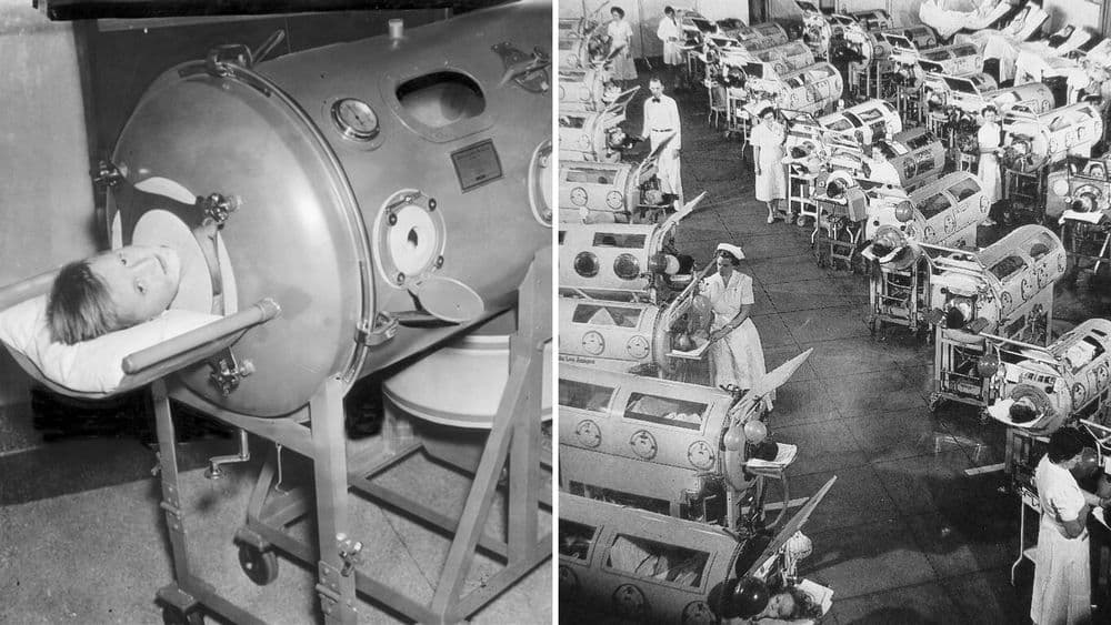 आयर्न लंग म्हणजे काय असतं? वाचा व्हेंटिलेटरच्या पूर्वजाची गोष्ट !!