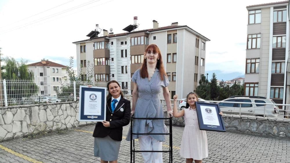 जगातील सर्वांत उंच स्त्री हे भूषण नव्हे तर व्हिव्हर सिंड्रोम नावाचा आजार आहे- वाचा रुमेसा गॅलगीची कहाणी !