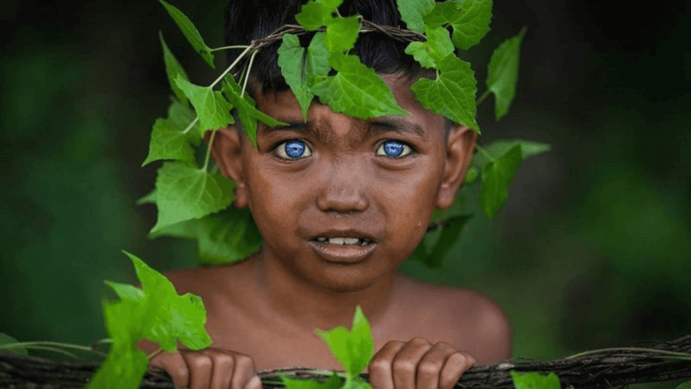 या सुंदर धगधगत्या निळ्या डोळ्यांमागे लपला आहे एक जनुकिय आजार !