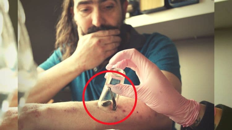 जळू लावणे - एकेकाळी गावठी समजला जाणाऱ्या उपचाराला मिळाली आंतरराष्ट्रीय मान्यता!!