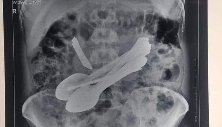 या व्यक्तीच्या पोटातून चक्क ८ चमचे, २ स्क्रूड्रायव्हर, २ टूथब्रश आणि एक चाकू निघाला ??