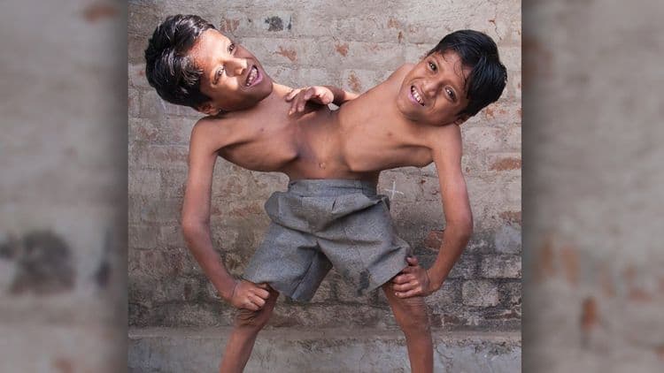 या जुळ्यांना का व्हायचं नाही एकमेकांपासून वेगळं ??