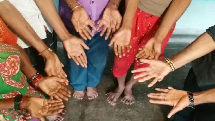 या एकाच कुटुंबात सगळ्यांना आहेत १० पेक्षा अधिक बोटं...वाचा या दुर्मिळ आजाराविषयी !!