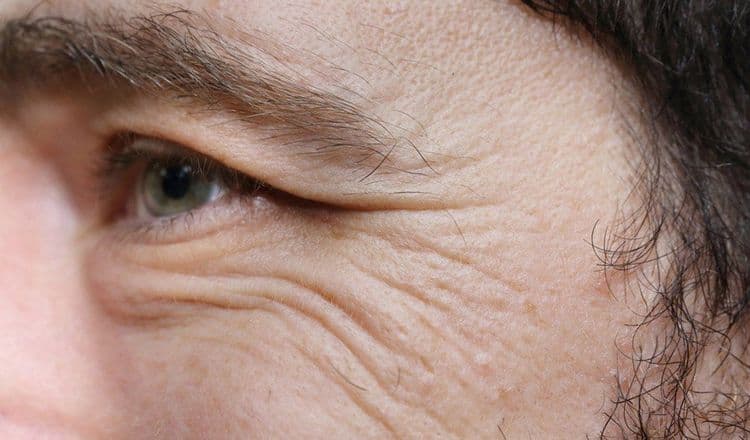 क्रो फीट रिंकल्स