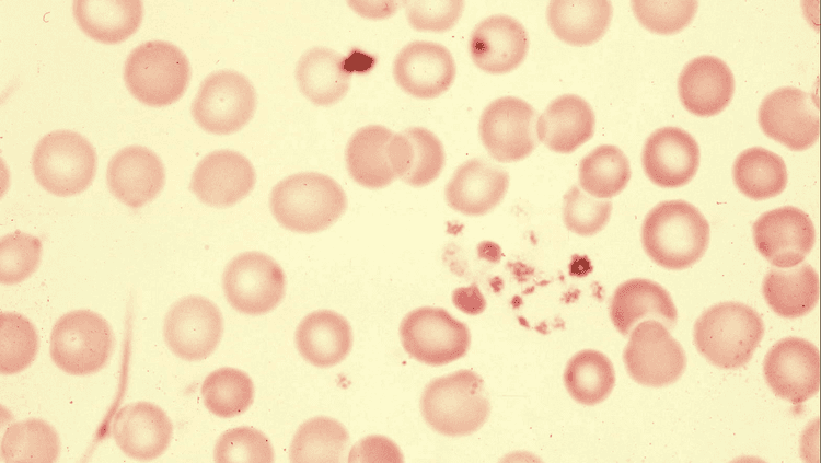 तीव्र ताप ? मळमळ? अंगदुखी ? लवकरात लवकर डॉक्टर कडे जाऊन रक्त तपासणी करून घेणे