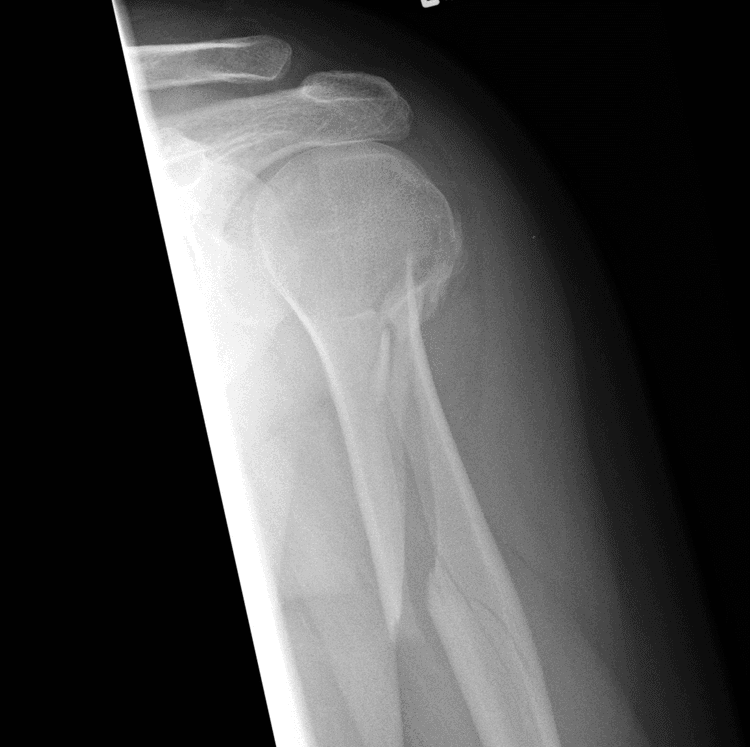 Spiral Fracture - हाडाच्या एखाद्या भागाला पीळ पडणे.