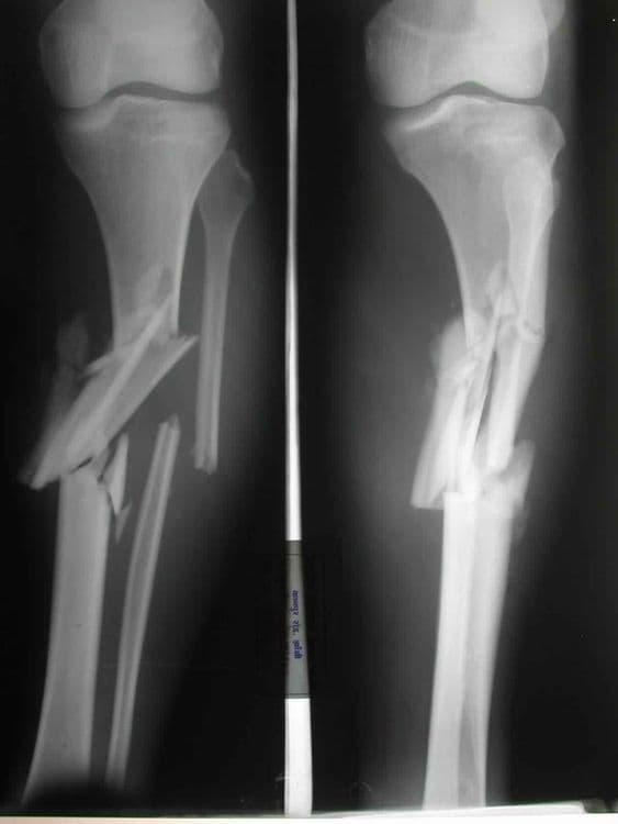 Comminuted Fracture - हाडांचा पूर्णतः चुरा होणे.