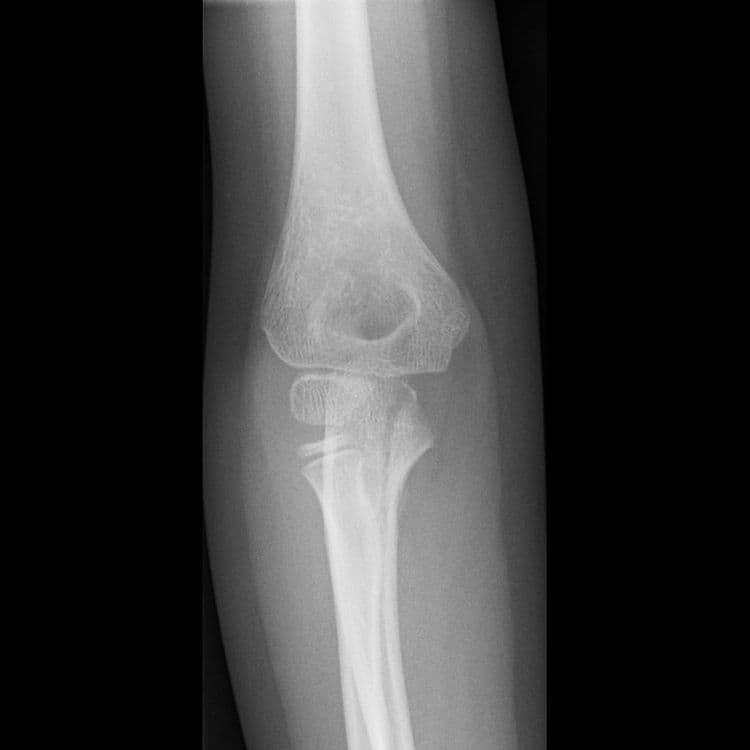 Longitudinal Fracture - हाडाच्या लांबीवर उभा तुकडा पडणे.