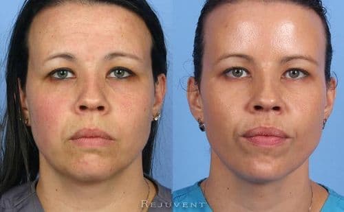 ५. केमिकल पील