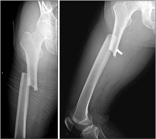 Oblique Fracture - हाडाच्या अक्षावर झालेले फ्रॅक्चर.