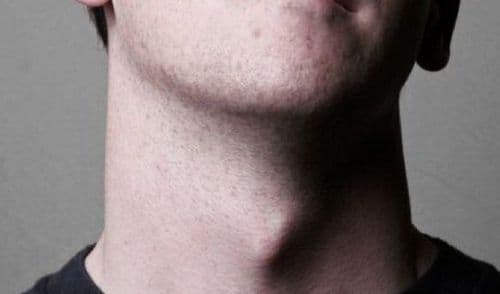 प्युबरफोनिया कोणाला होतो?